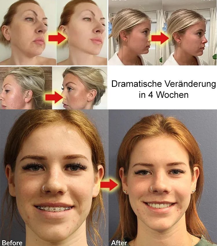 V-Mask™ - Magische Schlafmaske für schlankes Gesicht! - Frest